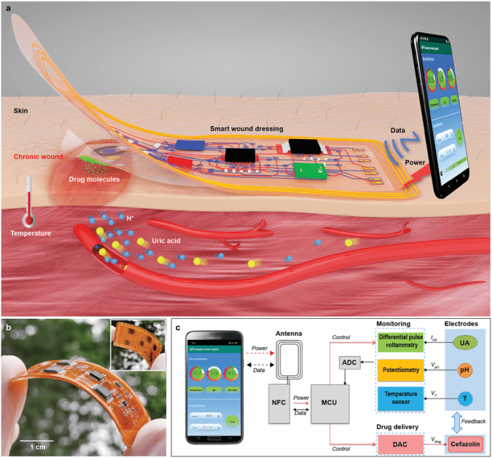 Smart wound dressing glows whenever bacteria are around
